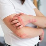 Falsa scabbia: sintomi, cause e trattamenti efficaci